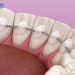 Dịch Vụ Cố Định Hàm 