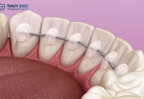 Dịch Vụ Cố Định Hàm 